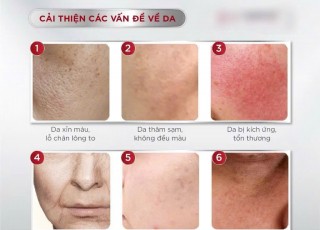 Nám Da Mặt - Chăm Sóc Da Khi Bị Nám